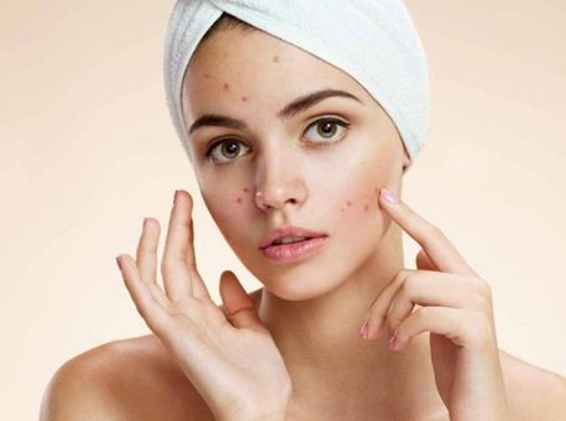 Tạm biệt làn da mụn chỉ với 6 bước