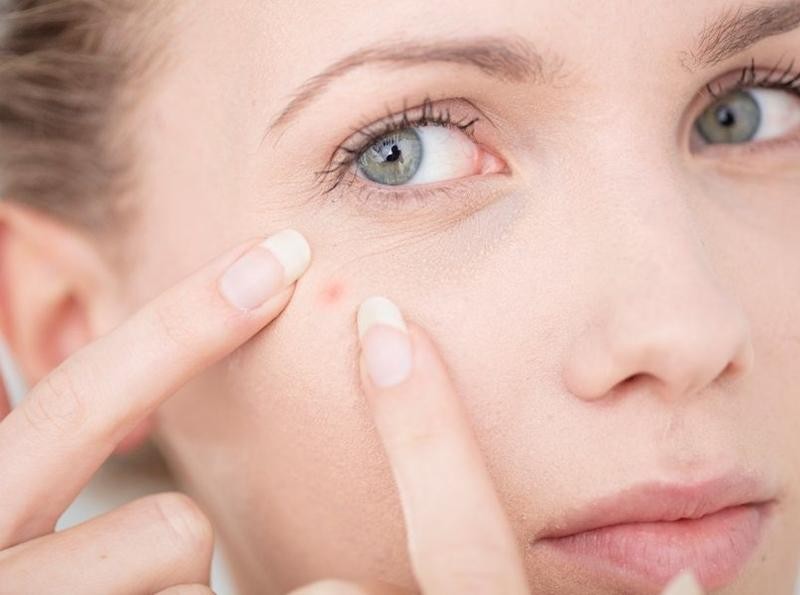 Giải mã nguyên nhân gây mụn trên từng vị trí của gương mặt