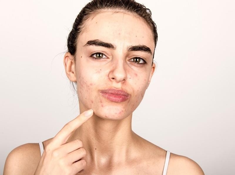 Vì đâu mụn mọc liên tục khiến miệng cười kém xinh?