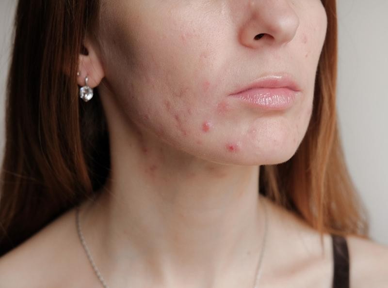 Đừng để mụn vì khẩu trang dây dưa sang tận năm Tân Sửu