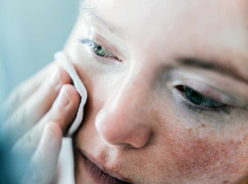 Vì sao da vẫn bị thâm đỏ sau khi mụn đã biến mất?