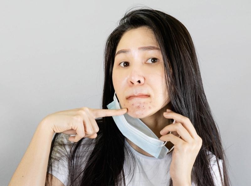 Nhận diện mụn do stress