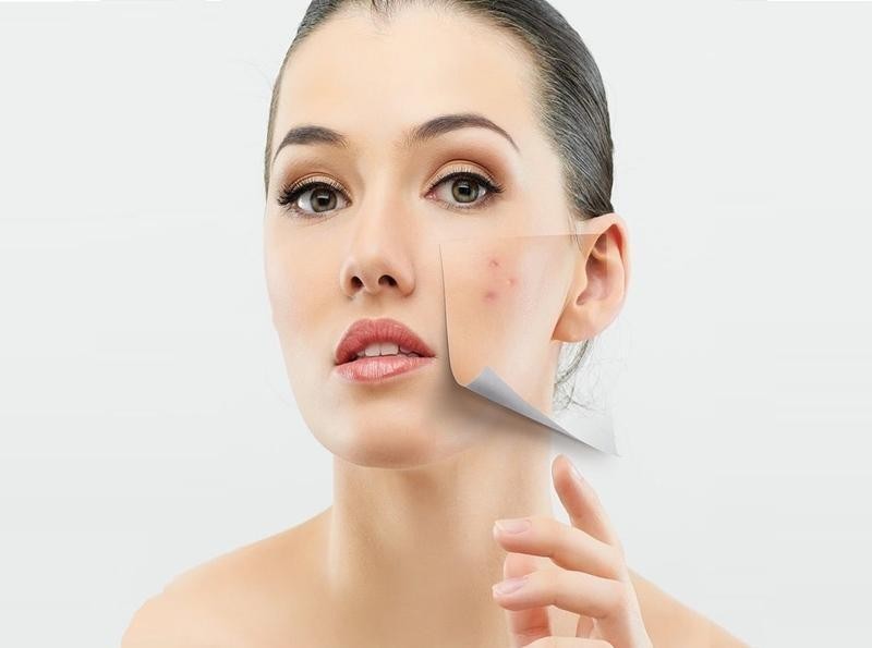 Những nguyên nhân gây mụn từ trong cơ thể