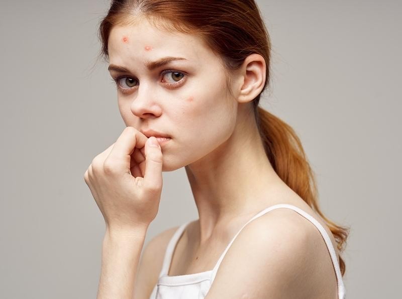 Làm sao để đối phó với mụn gần kỳ kinh nguyệt?