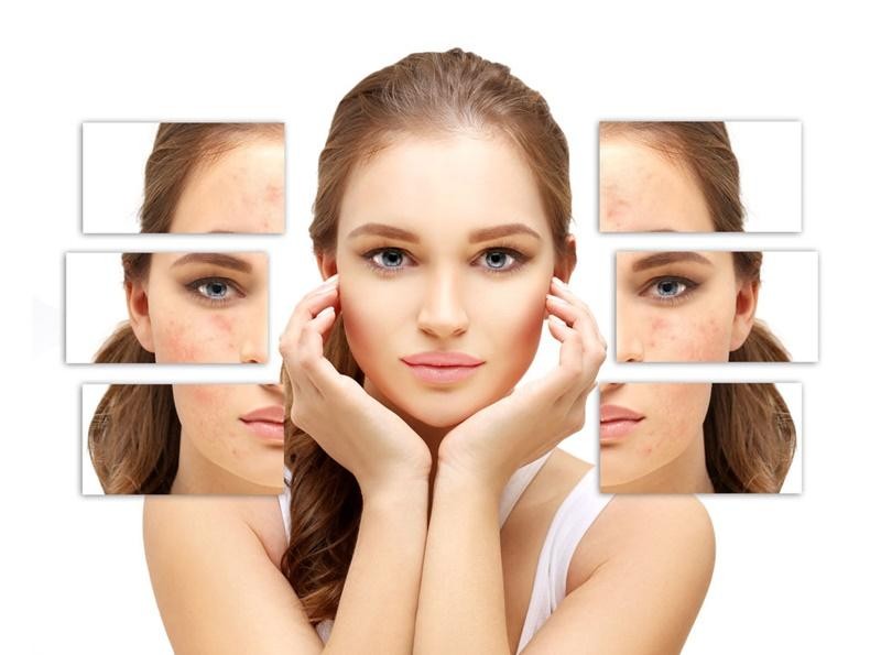 Những bước để bạn tiễn thâm sẹo đi cùng năm Canh Tý